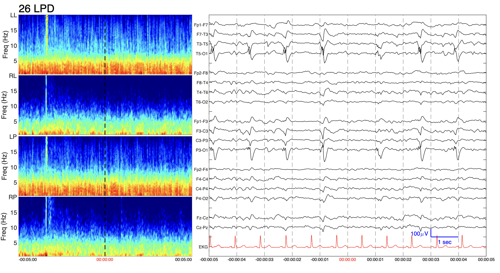 HMS Brain Activity Classification